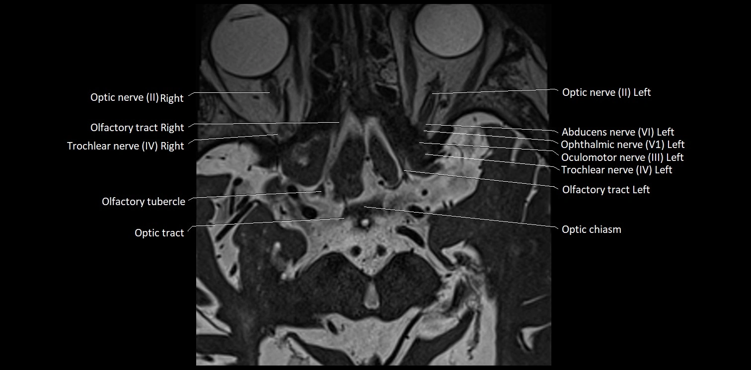 Cranial nerve anatomy axial MRI 3T image 10.webp